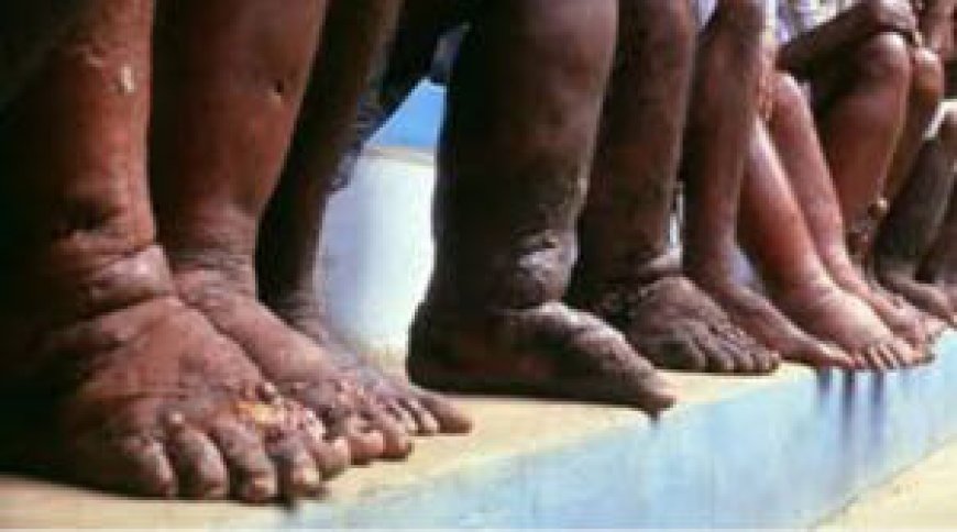 Why Nairobians Will Soon Start Having Swollen Legs and Other Body Parts?